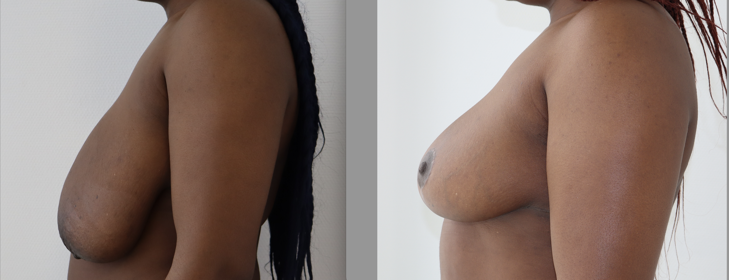 Avant/Après lifting seins et réduction mammaire